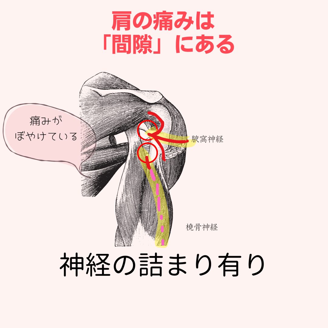 四辺形間隙